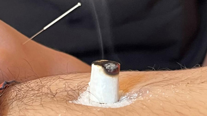 Moxatherapie